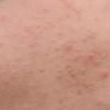 Điều trị mụn triệt để